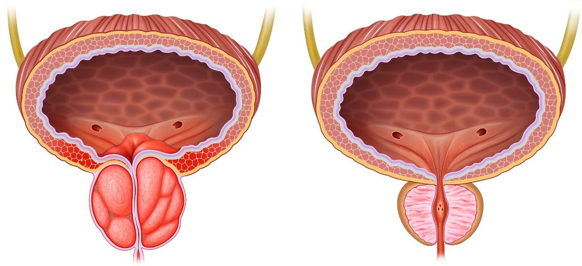 prostate saine et malade