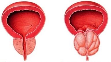 Prostate sain et enflammée de prostatite