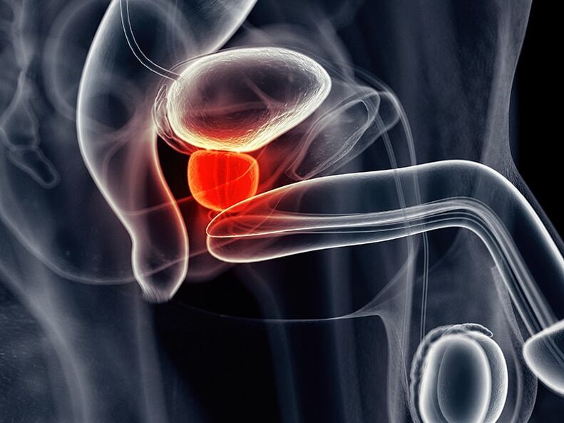 Inflammation de la prostate accompagnant la prostatite chronique